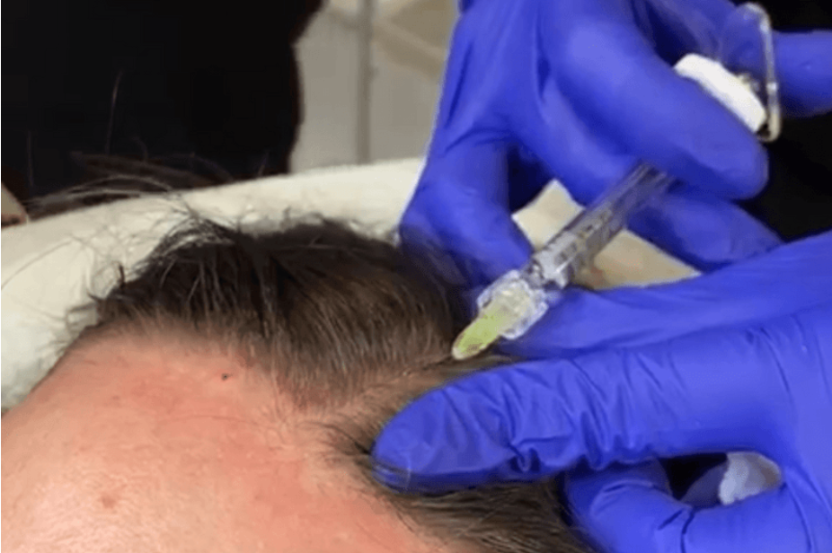 Hair Filler Rejuvenation