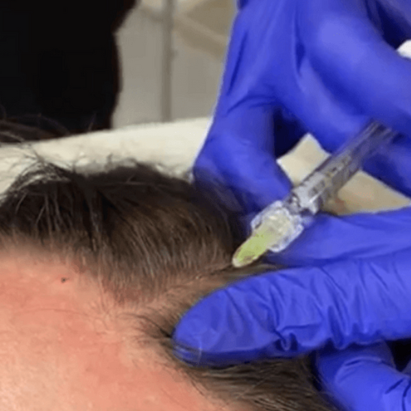 Hair Filler Rejuvenation